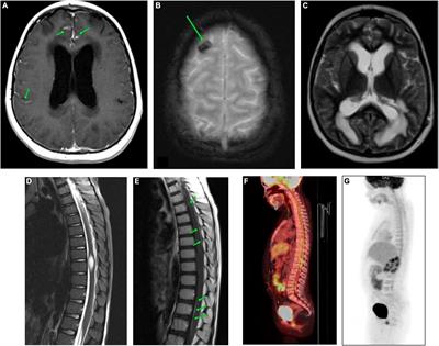 Case Report: Primary Leptomeningeal Medulloblastoma in a Child: Clinical Case Report and Literature Review